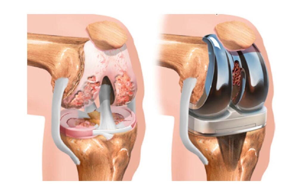 cirugia protesis rodilla artroplastia rodilla lima peru 01 Traumatologo Ortopedista en Tijuana https://traumatologoentijuana.com