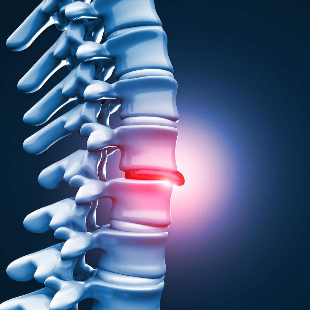 tratamiento de hernias de disco en tijuana