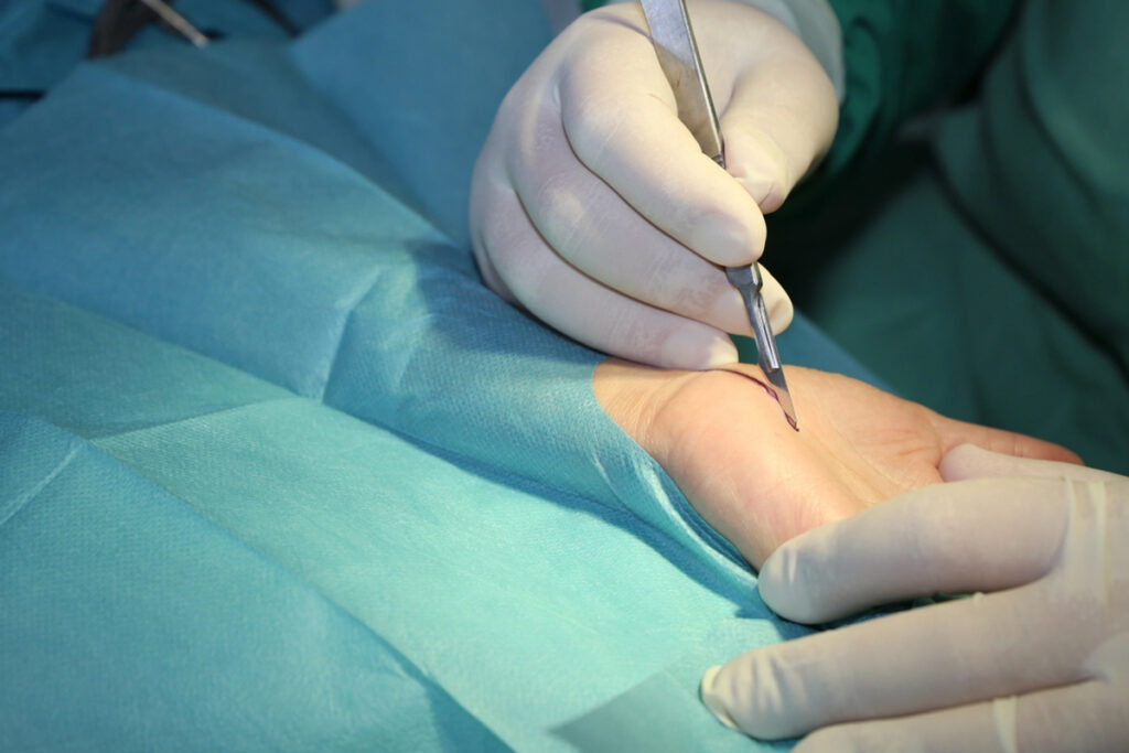 Fractura de Muñeca 8 Cirugia de Muneca en Tijuana Traumatologo Ortopedista en Tijuana https://traumatologoentijuana.com