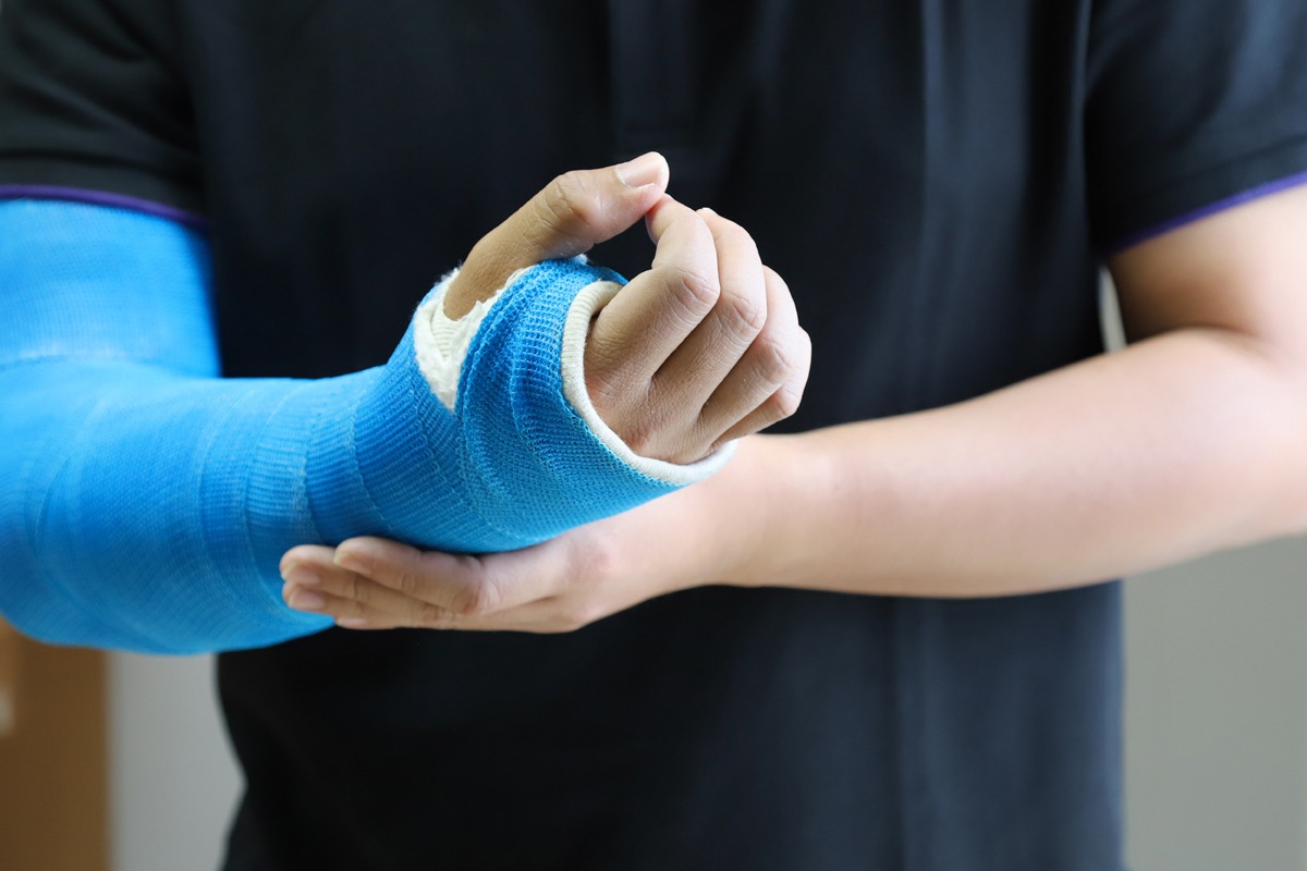Fractura de Brazo en Tijuana Fractura de Brazo en Tijuana