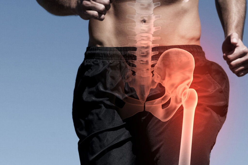 Fracturas 9 Fractura de Cadera en Tijuana Traumatologo Ortopedista en Tijuana https://traumatologoentijuana.com