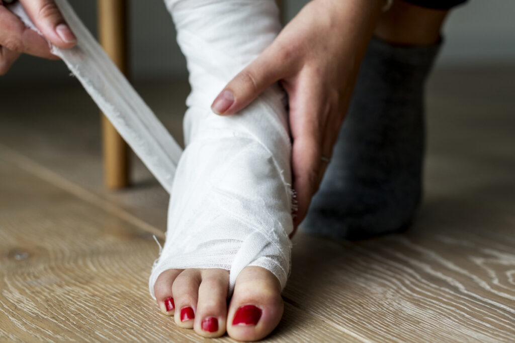 Fracturas 11 Fractura de Pie en Tijuana Traumatologo Ortopedista en Tijuana https://traumatologoentijuana.com