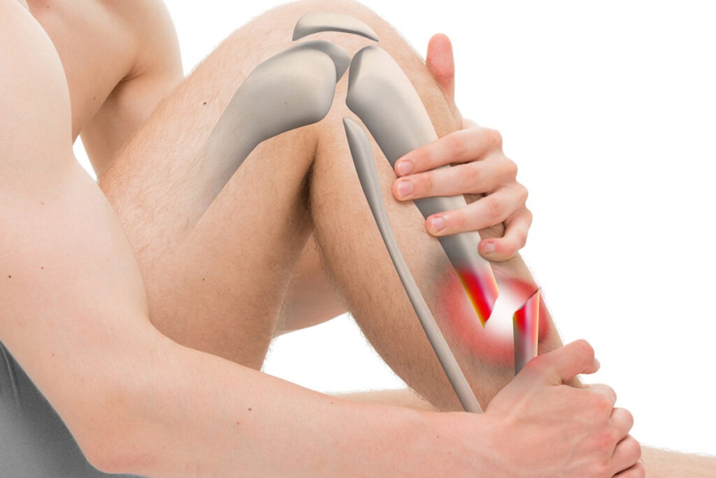 Fracturas 10 Fractura de Pierna en Tijuana Traumatologo Ortopedista en Tijuana https://traumatologoentijuana.com