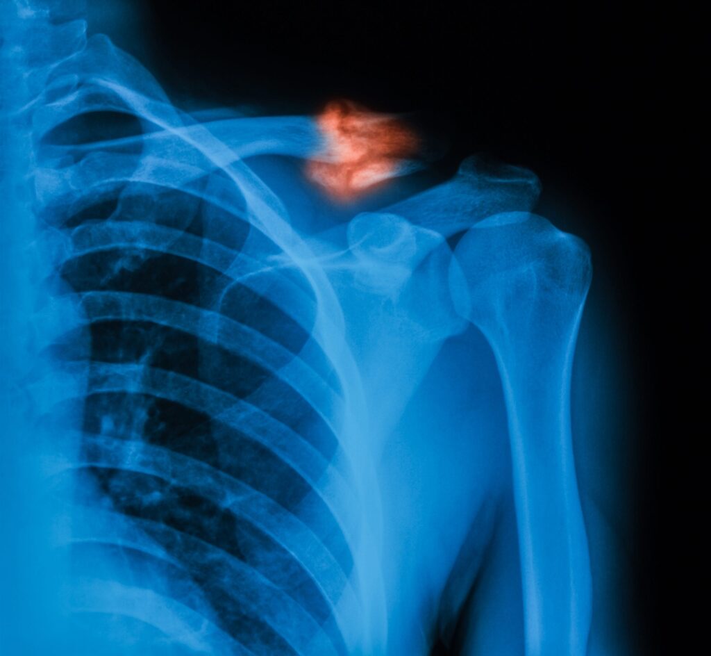 Fractura de Clavícula en Tijuana: Diagnóstico y Tratamiento 7 Fractura de Clavicula en Tijuana Traumatologo Ortopedista en Tijuana https://traumatologoentijuana.com