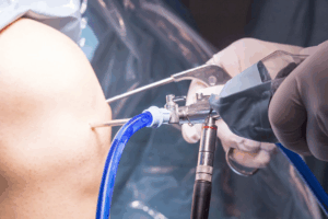 Artroscopia de Rodilla en Tijuana Cirugia de Rodilla