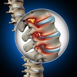 Spinal Stenosis medical concept as a degenerative illness in the human vertebrae causing compressed spine nerves human body disease as a 3D illustration.